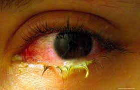 Eye problems due to bad air quality